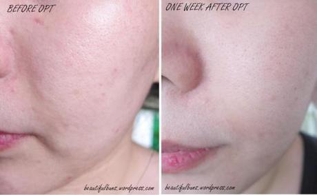 Review: Optimal Pulse Technology OPT by Lumenis OPT 5