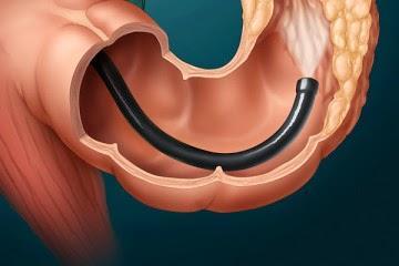 {Inflammatory Bowel Disease - My Colonoscopy Experience}