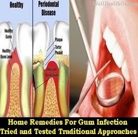 Home Remedies For Gum Disease