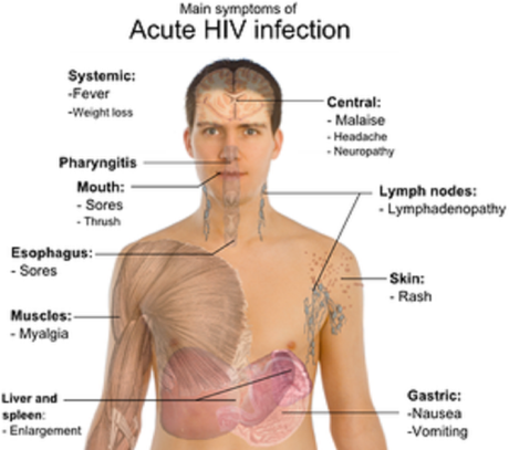 HIV symptoms