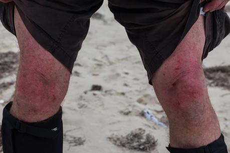 cut knees from scrub hiking