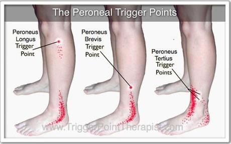 peroneal-trigger-points