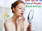 Best Tips Taking Care Pimples Mouth Lips