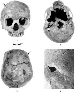 The Qafzeh 11 skull. The arrow points to the head trauma