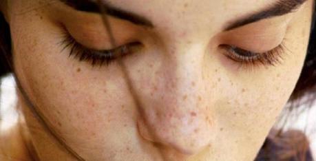 Home Remedies to Get Rid of Age Spots Home Remedies to Get Rid of Age Spots