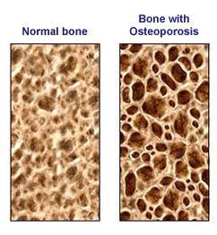 osteoporosis and anorexia