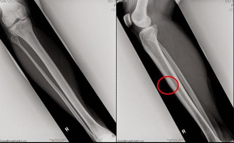 FREEDOM!!!!! (a fracture update)