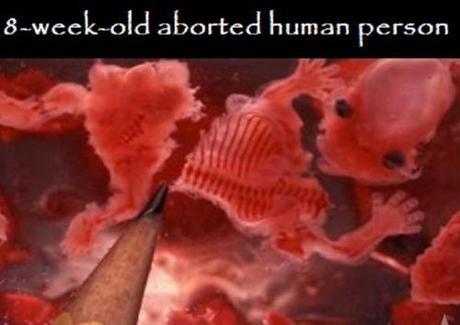 8-week-aborted-fetus