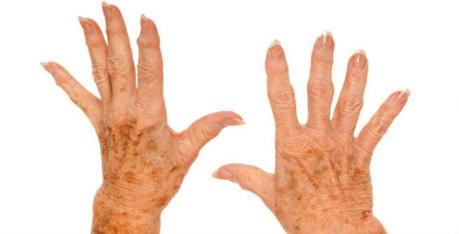 Liver Spots on Hands