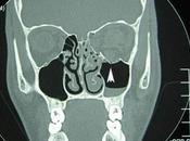 Officer Darren Wilson Suffered “Orbital Blowout Fracture Socket”