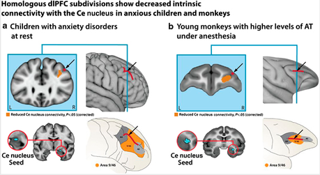 Early life anxiety in monkeys and humans correlates with connectivity between prefrontal cortex and amygdala.