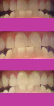 Smile Brilliant Teeth Whitening