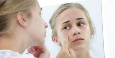 Yogurt Face Masks for Acne