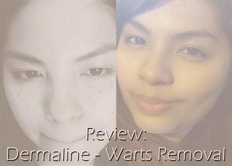 Review: Dermaline - Warts Removal