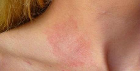 Allergic Reactions from Hydroquinone 