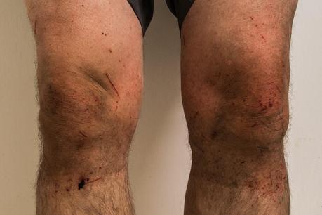 cuts on legs from hiking