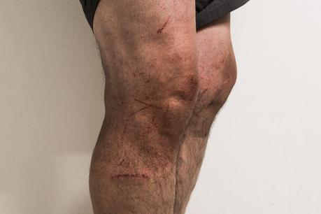 cuts on legs from hiking